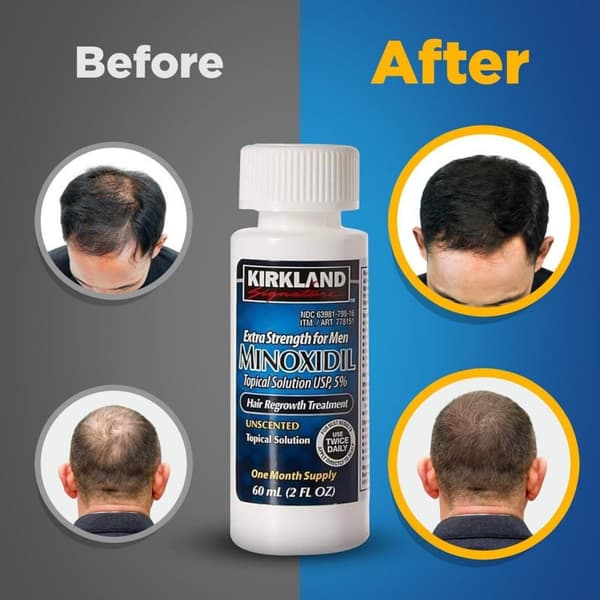 Kirkland Minoxidil 5% Håravfallsspray 6*60ml