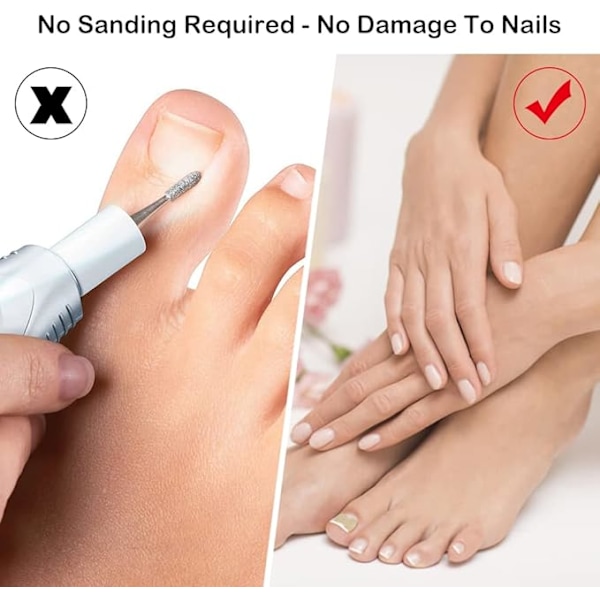 #50 STK, Inväxt Nagelplåster, Inväxt Nagelplåster, Nagelkorrigering