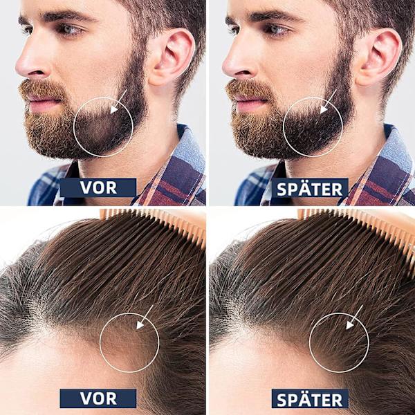 Derma Roller Rostfritt Stål Svart Mikronålsrulle 0,25 mm