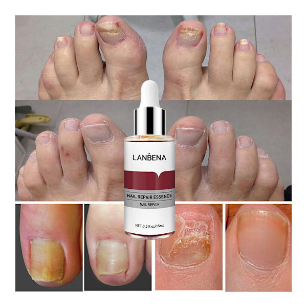 Nail Treatment Nail Repair Essence Foot Care