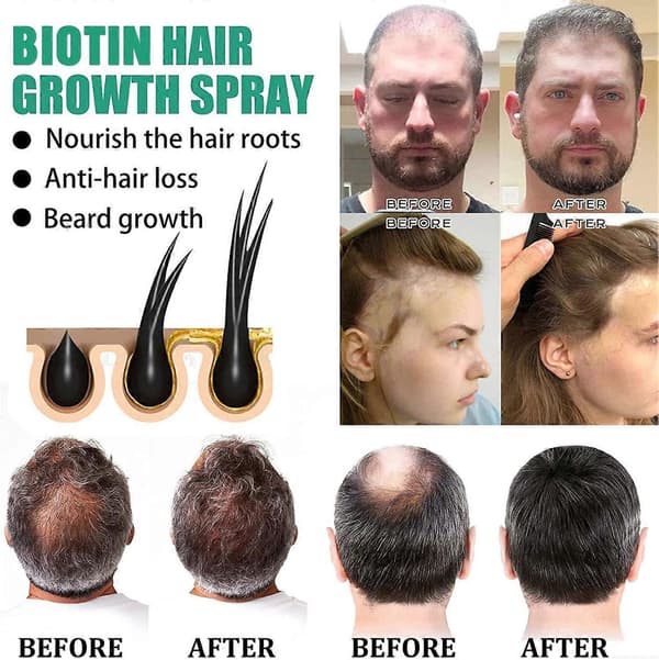 Biotin Hårbotten Närande Spray Serum, Stärkande Hårvårdsessens 20ml