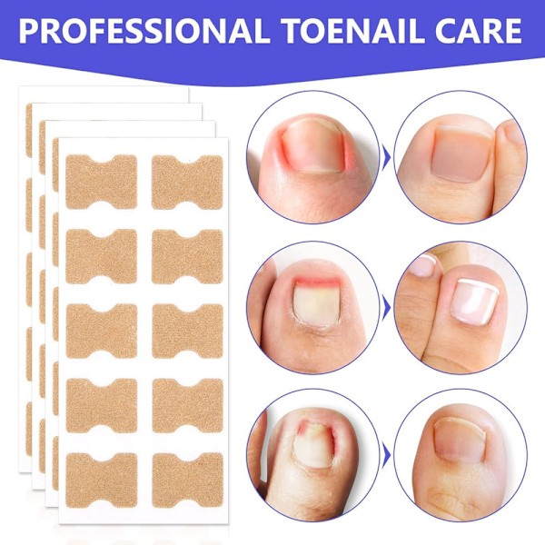 Nageltrångsbehandling, 100 st Andningsbara Korrigeringsplåster, Smärtfri Nagelkorrigering, Nageltrångsplåster, Behandling av Nageltrång