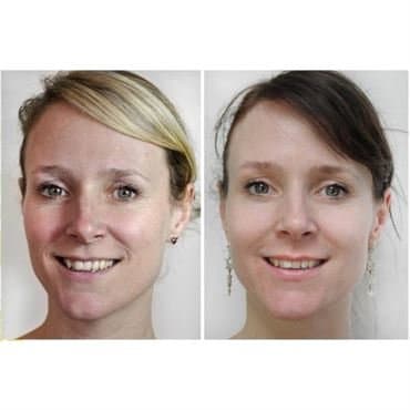DRS Dermaroller 540 mikronåler 0,5 mm - Ansikt