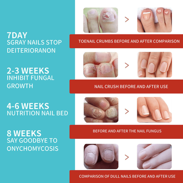 Nagelreparationsplåster Svampnagelreparationsbehandling för att återställa skadade naglar och utseende av missfärgade