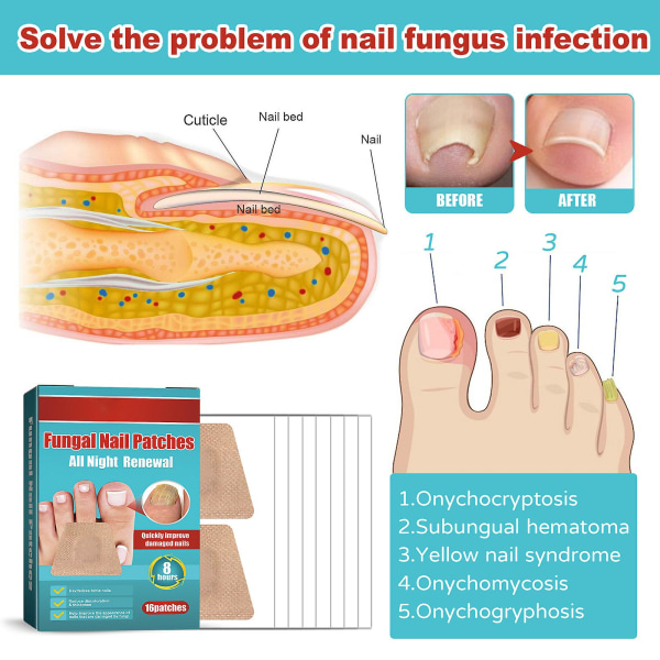 Nagelreparationsplåster Svampnagelreparationsbehandling för att återställa skadade naglar och utseende av missfärgade
