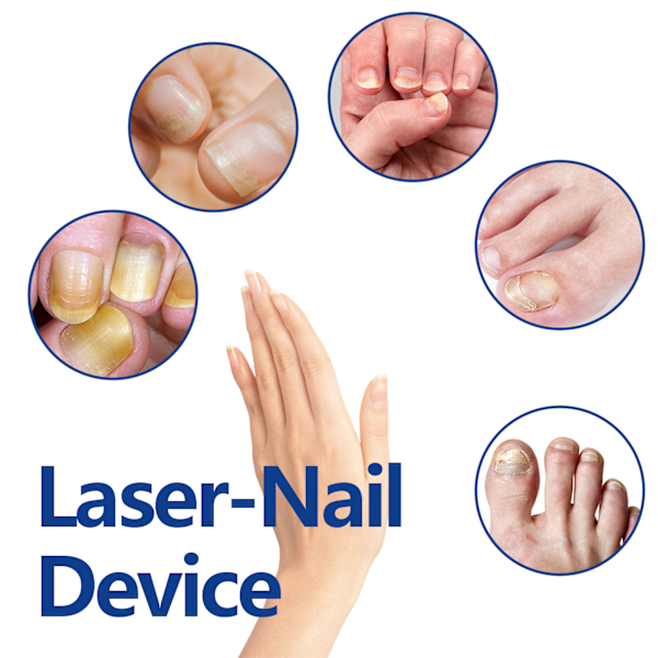 2025 Senaste Modell Laser-Nagel Apparat, Reparerar Ruttna Naglar Dåliga Naglar Förtjockning Mjuka Naglar, Hand, Fot Och Nagel Grå Vård Ljusterapi