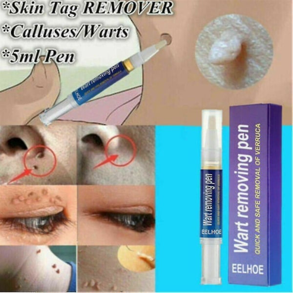 Wart Remover Pen Skin Tag Mole Remover Eliminera Foot Corn Warts Treatment Cream