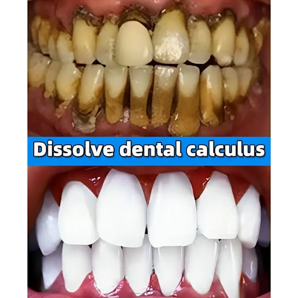 Tannstein Fjerner Tannkrem Bleking Tenner Munnlukt Fjerning Dårlig ånde Forebyggende Periodontitt Probiotisk tannkrem{EE}