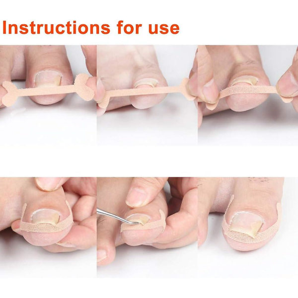 Klistermärken för tånagelkorrigering, 24 st Paronychia Treatment Band-klistermärken Tånagelkorrigeringsbandage Fotvårdsverktyg för att lindra smärta