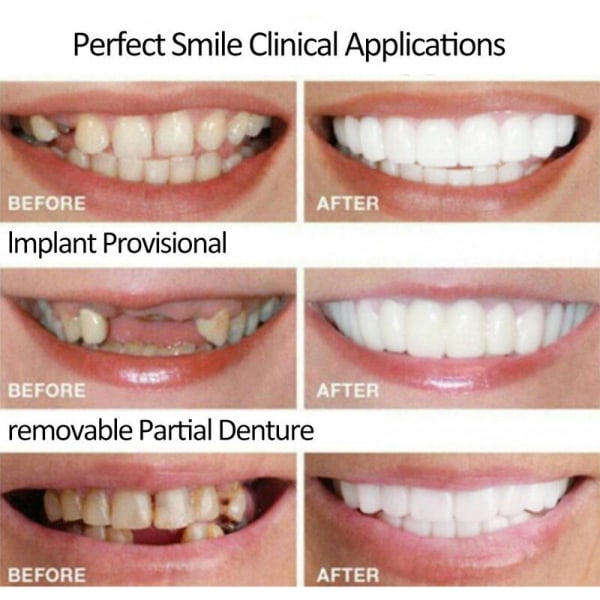 2 sæt proteser, øvre og nedre proteser, naturlige og komfortable, beskytter tænderne og genopretter et selvsikkert smil