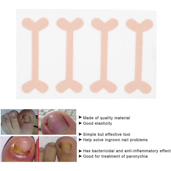 Klistermärken för tånagelkorrigering, 24 st Paronychia Treatment Band-klistermärken Tånagelkorrigeringsbandage Fotvårdsverktyg för att lindra smärta