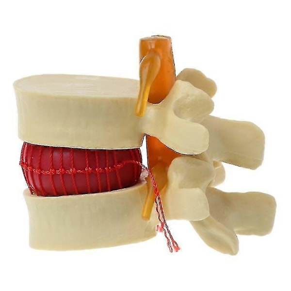 Lumbal Spinal Disk Brok Rygsøjle Anatomisk Anatoyellow1stk Banmo