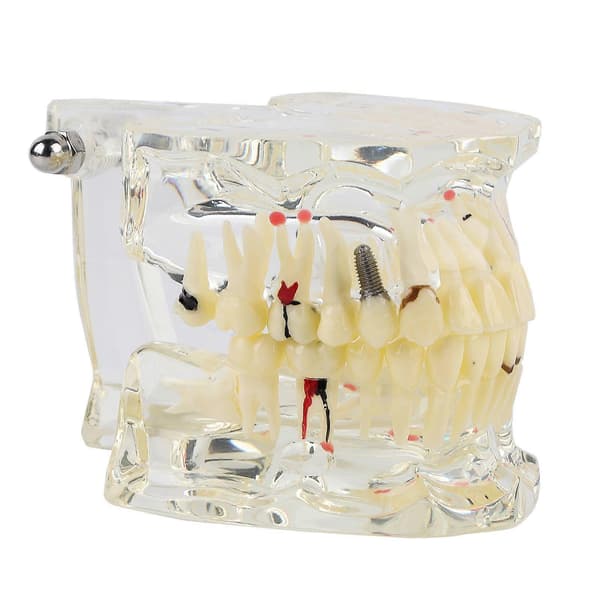 Ny Dental Undervisning Studie Standard Tandmodell Demonstration Sjukdom Utbildning