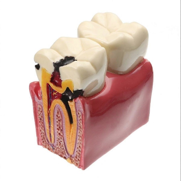 Hammaskariestaudin hammasmalli, YOUYA DENTAL Kariestaudin hampaiden vertaileva tutkimusmalli 6 kertaa Kariestaudin hampaiden opetusvälineet