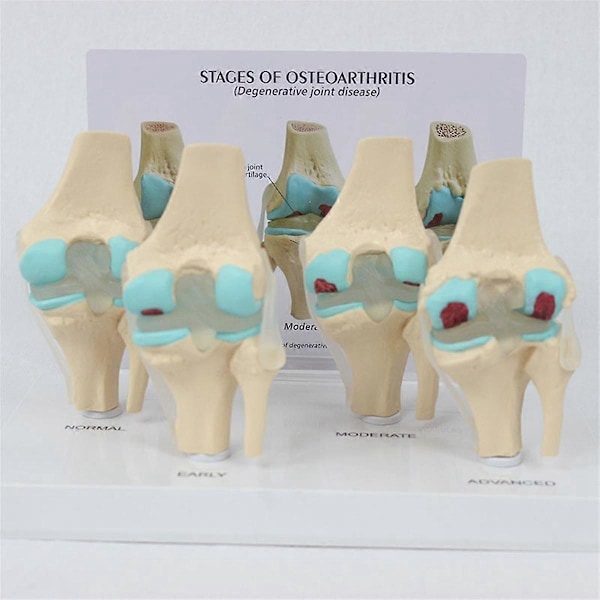 Knæ Kit Osteoarthritis Anatomi Model med Uddannelsesmæssigt Nøglekort 4-Trins Knæmodel Ortopædiske Undervisningshjælpemidler