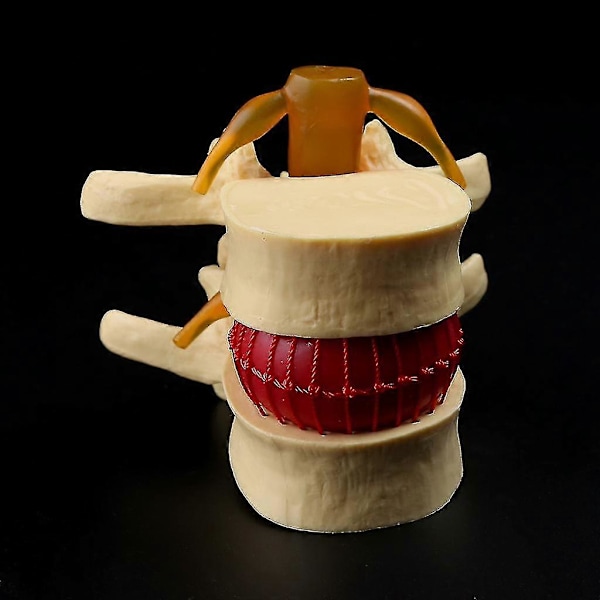Lumbal Spinal Disk Brok Rygsøjle Anatomisk Anatoyellow1stk Banmo