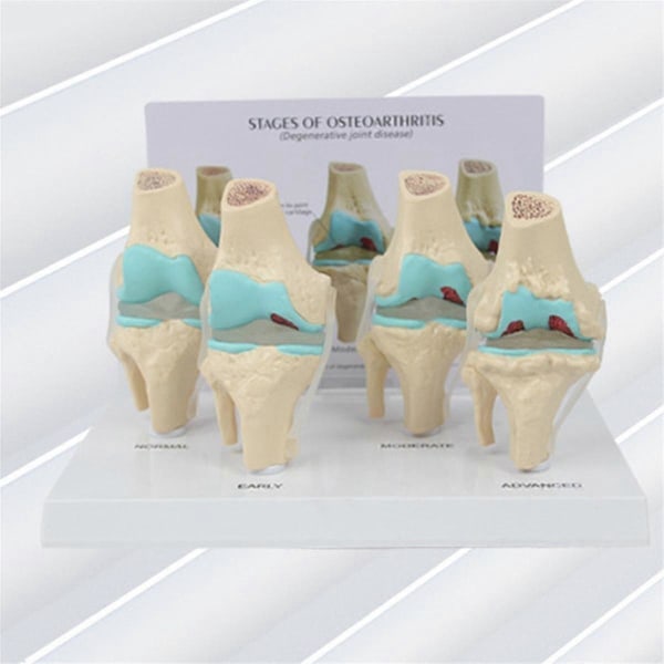 Knæ Kit Osteoarthritis Anatomi Model med Uddannelsesmæssigt Nøglekort 4-Trins Knæmodel Ortopædiske Undervisningshjælpemidler