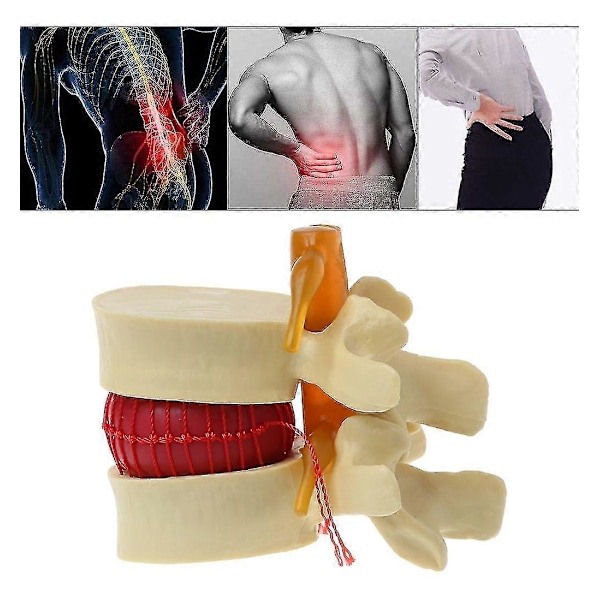 Lumbal Spinal Disk Brok Rygsøjle Anatomisk Anatoyellow1stk Banmo