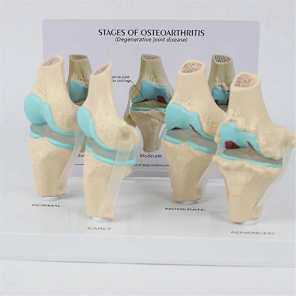 Knæ Kit Osteoarthritis Anatomi Model med Uddannelsesmæssigt Nøglekort 4-Trins Knæmodel Ortopædiske Undervisningshjælpemidler