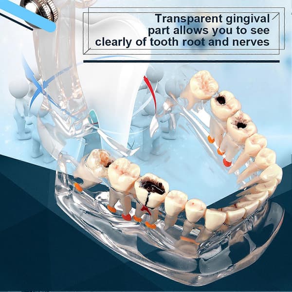 Ny Dental Undervisning Studie Standard Tandmodell Demonstration Sjukdom Utbildning