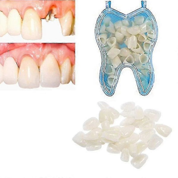 Tillfälliga Tandställningsskenor för att täcka Övre Proteser, Veneers, Saknade Tänder