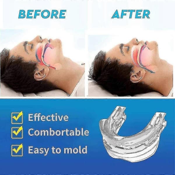 Anti-snoring munnstykke, enhet for søvnstøtte, justerbare munnstykker, varm