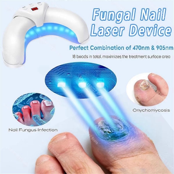 Nagellaserbehandlingsenhet Fingernagel Behandla Onykomykos Effektivt Ta Bort Onykomykos Växa Till