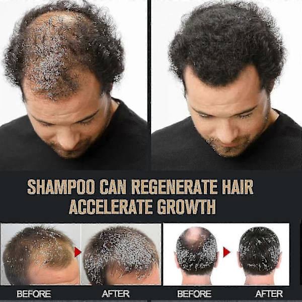 Root Activator Shampoo, Mane Root Activator Shampoo, Shampoo Root Activator Främjar Hårväxt För Män Hårförtjockningsschampo 1pcs