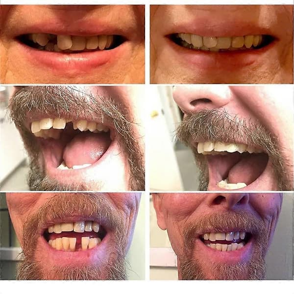 MULTI-SHADE INSTANT Midlertidig SMILE ERSTATNINGSTANNSETT