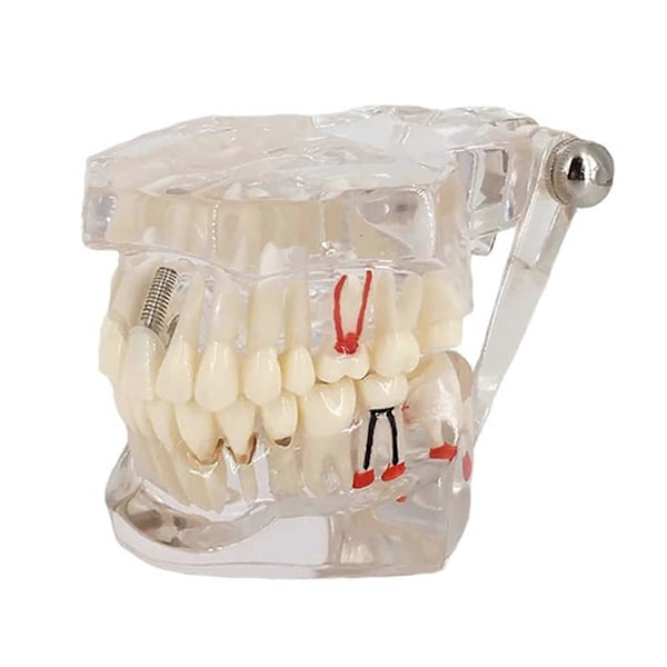 Transparent Sjukdoms Tandmodell, Transparent Tandimplantat Tandmodell Tandläkare Standard Sjukdom Avtagbar Tand Patologisk Undervisningsmodell