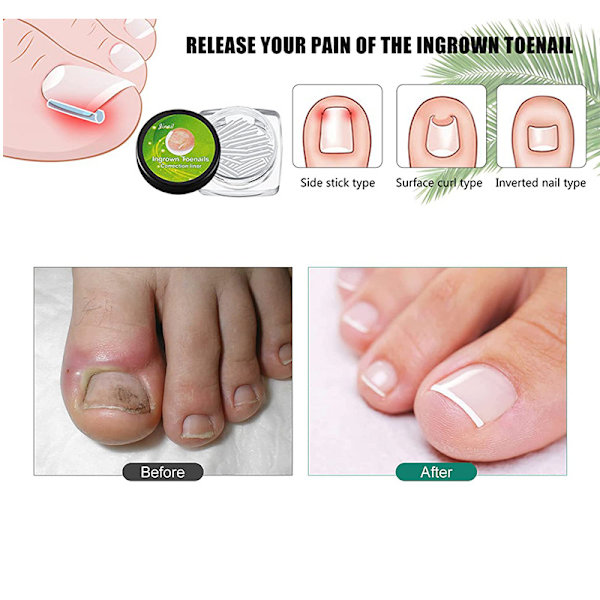 20 st Ingrown Toenail Patch Ingrown Toenail Verktyg  Kvinnor Fot Nagelvård