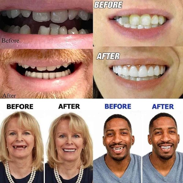 Kosmetiska övre nedre tänder anländer platt. Yourself Smile Makeover!