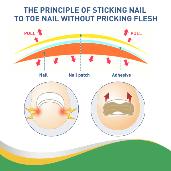 Nagelplåster, Health Toenail Corrector Patch, Inåtväxt tånagel Cor