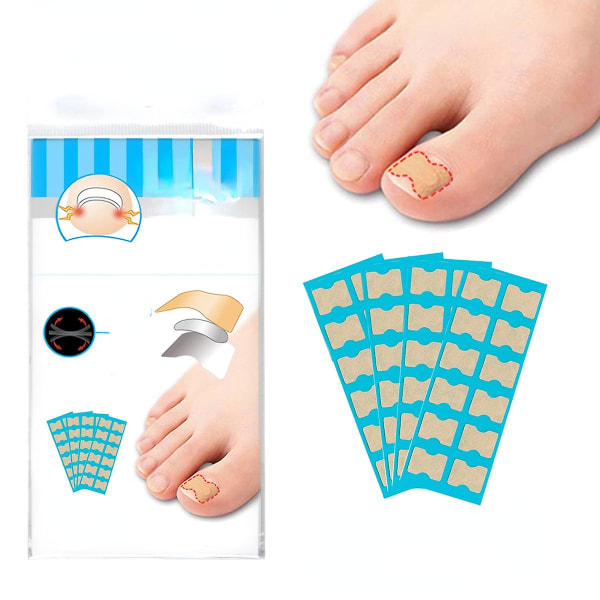 120st limfritt inåtväxande nagelpasta Verktyg för inåtväxande nagelkorrigering