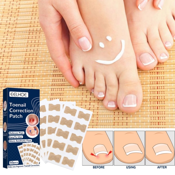 Klistremerker for korrigering av tånegler, klistremerker for korrigering av inngrodde tånegler, uten lim