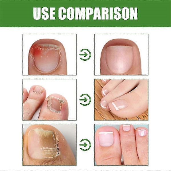 1-3 st Nageloljeroller - Näringsgivande Massage För Starkare, Snabbare Växande Naglar Med 7-dagars Nagelväxtformula (C)