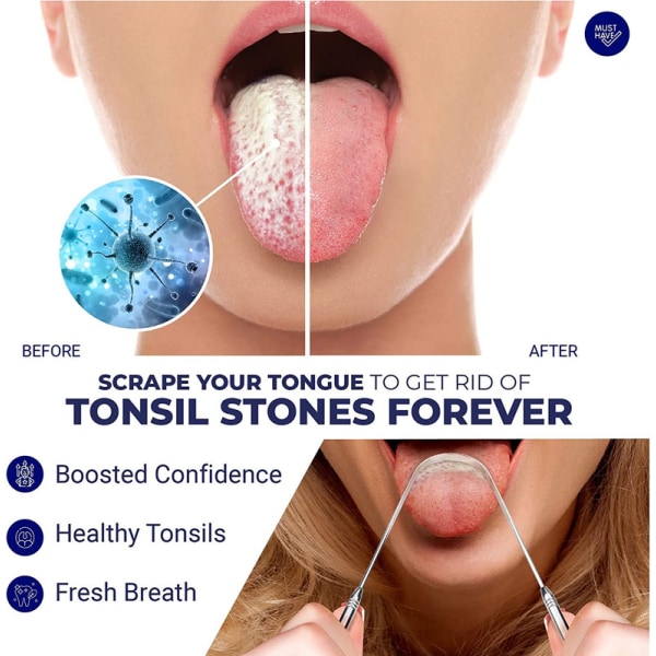 tar bort stenar från tonsiller | Kit för borttagning av tonsillsten