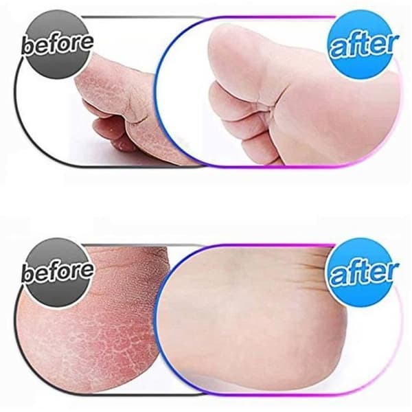 Universal USB foot file with extra coarse replacement rollers for removing dead skin and calluses [Coarse grain; 6-pack]
