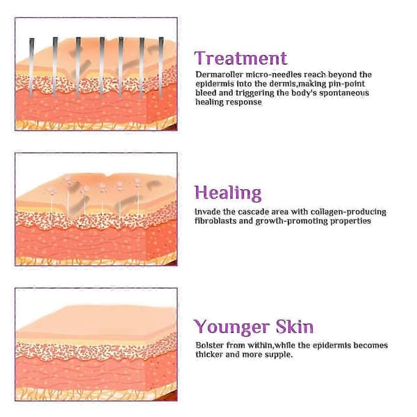 6-i-1 Microneedle Derma Roller, 0,25 / 0,5 / 1 mm, Derma Roller til Krop og Ansigt, Mikronålerulle i Rustfrit Stål til Bekæmpelse af Rynker, Graviditet