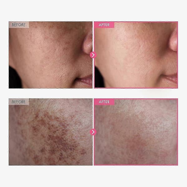 2-pakning 50g ansiktskrem med Arbutin og Tranexamsyre