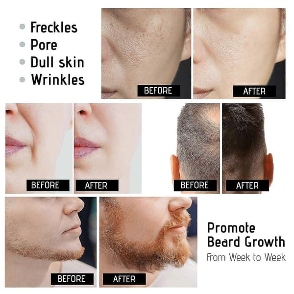 Derma Roller Microneedle Roller För Ansikte, Skäggroller, Microneedling Roller Skäggväxtkit, Hårväxt Skäggvårdskit | För Kvinnor och Män Hudvård