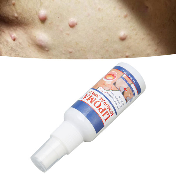 50 ml spray för borttagning av lipom, spray för borttagning av subkutana fettknölar för eliminering av fettblockering