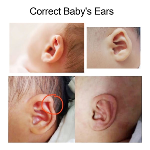 Æstetisk korrigerende babyørekorrektion til spædbørn, korrigering af udstående ører 4 X 50 cm Silic Børneøre Æstetiske korrigerende mærkater