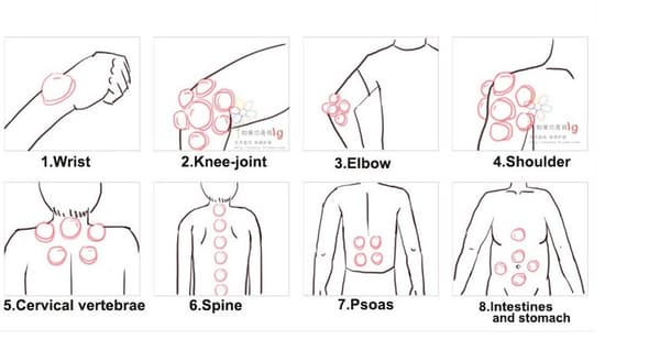 Silikone massagekopper, blå - cupping sæt