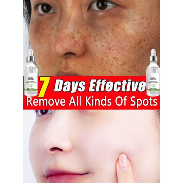 Anti mørke plet Fjern fregner chloasma hyperpigmentering blegning lys alder sol Melasma Kloasma Fjerner æterisk olie