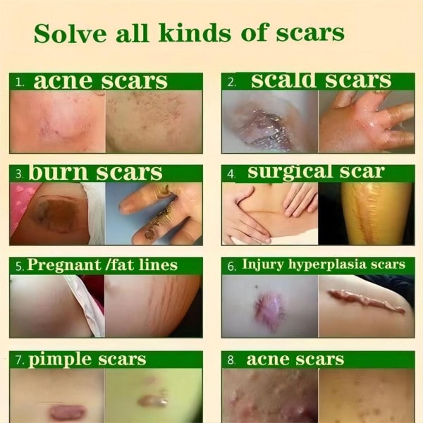 Ar fjernelse creme gel fjern acne pletter behandling stræk mærker forbrænding kirurgi ar reparation creme