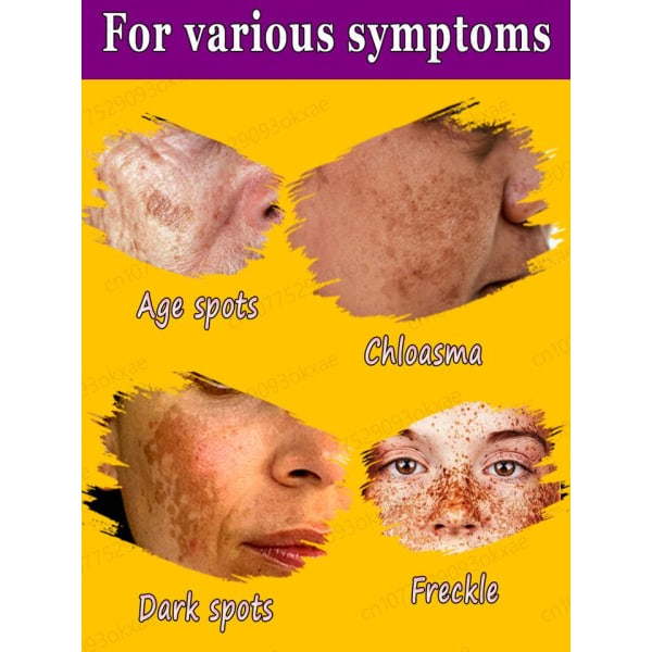Mørk flekk fjerner for ansikt fjern melasma fjerning depigmentering