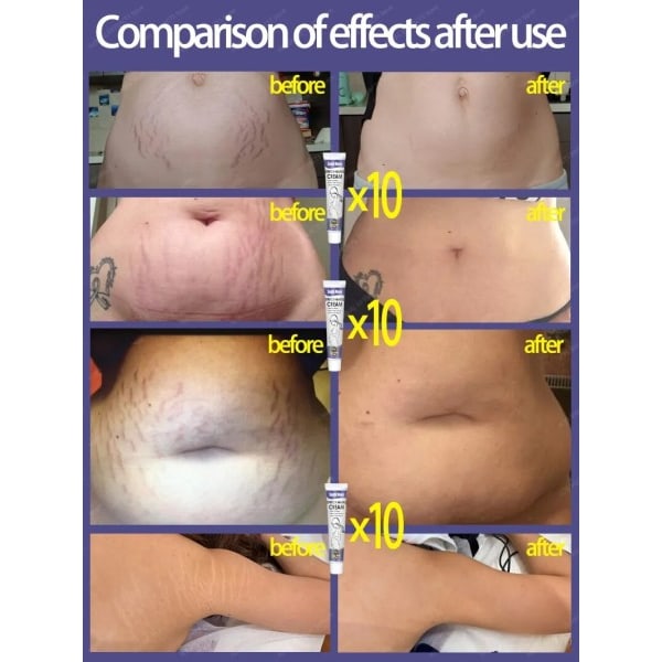 Stretch Marks Permanent Removal Cream Eliminate Body Belly Stretch Marks För tunnlar