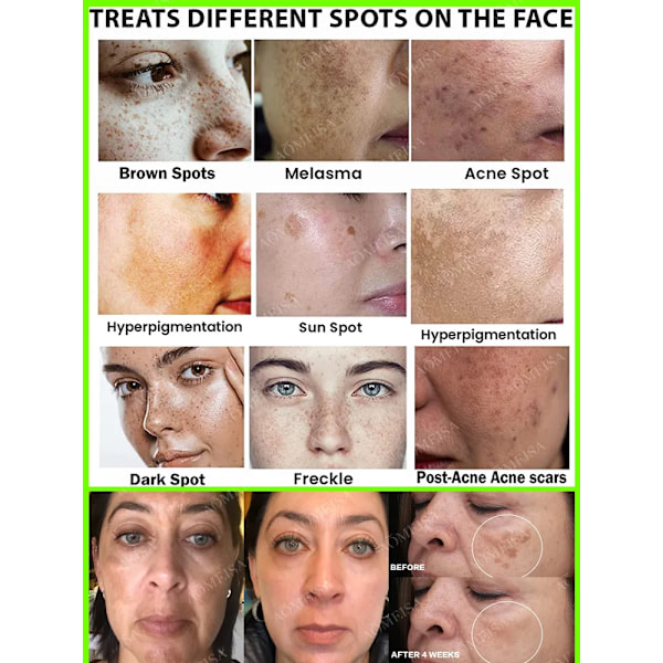 Mørke flekker fjerner for ansikt sol melasma fregner pigment alder flekker fjerning