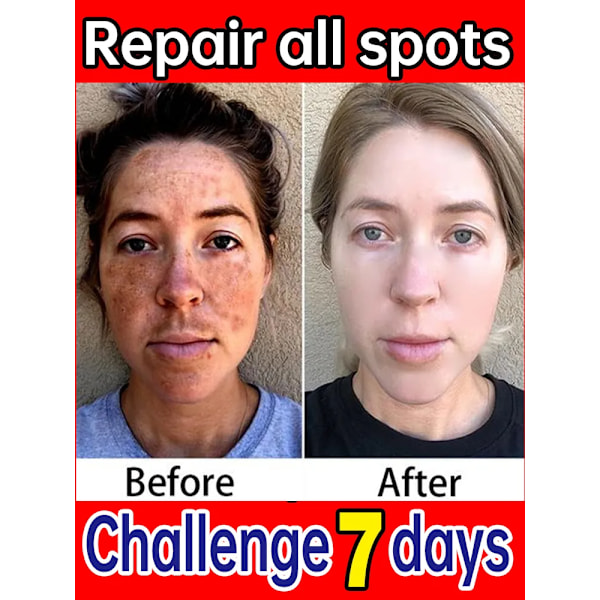 Mørke flekker fjerner for ansikt sol melasma fregner pigment alder flekker fjerning